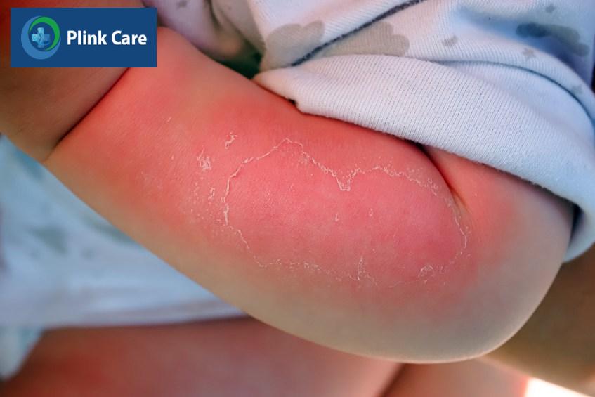 Bỏng nước sôi khiến da sưng đỏ, rát, đau đớn