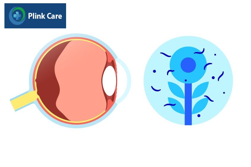 các đốm đen trong mắt người bệnh