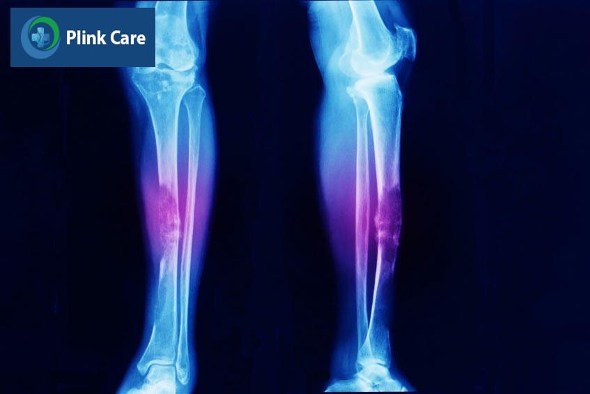 Cách cải thiện loạn sản sợi xương