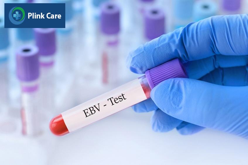 chỉ định xét nghiệm ebv tầm soát ung thư vòm họng