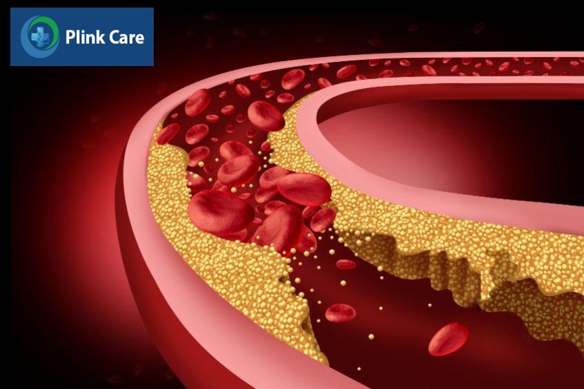 Cholesterol cao làm tăng mảng bám tích tụ ở thành động mạch gây cản trở lưu thông máu