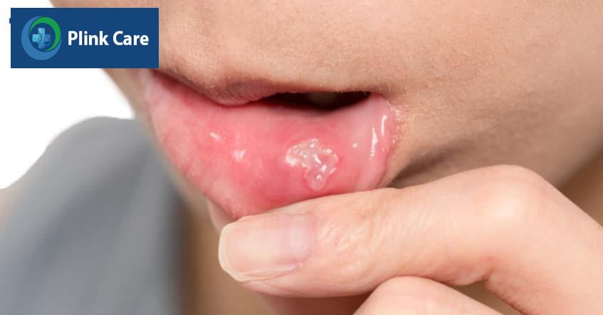 Chữa nhiệt miệng hiệu quả bằng thuốc