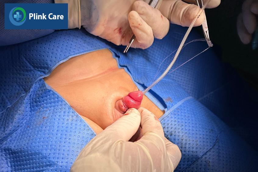 Cố định vị trí dương vật cho trẻ