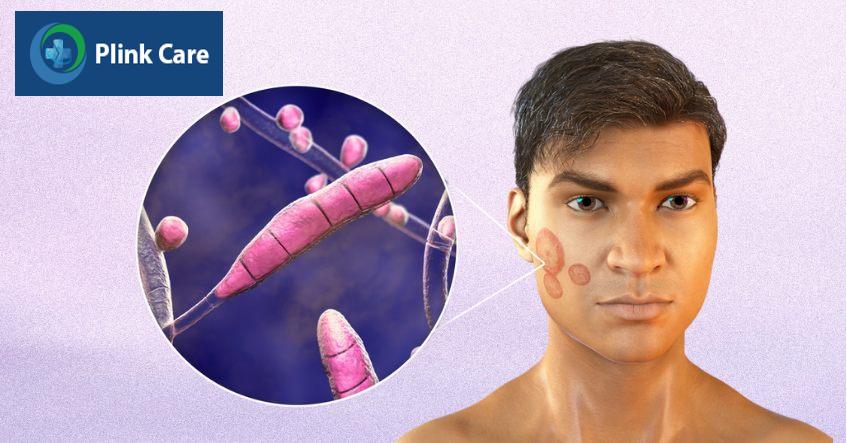 có nhiều chủng loại nấm da mặt khác nhau