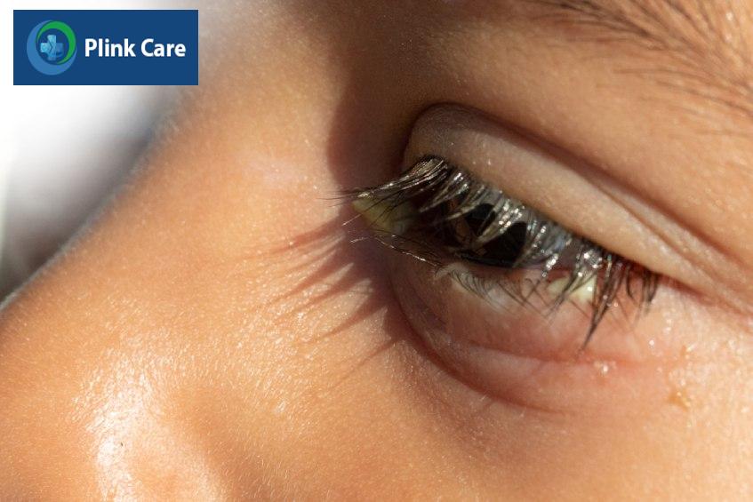 có nhiều nguyên nhân mắt đổ ghèn khi ngủ dậy