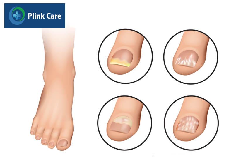 Dấu hiệu bị nấm móng