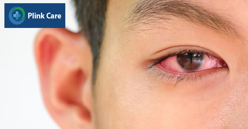 đeo lens bị đỏ mắt dễ gây biến chứng