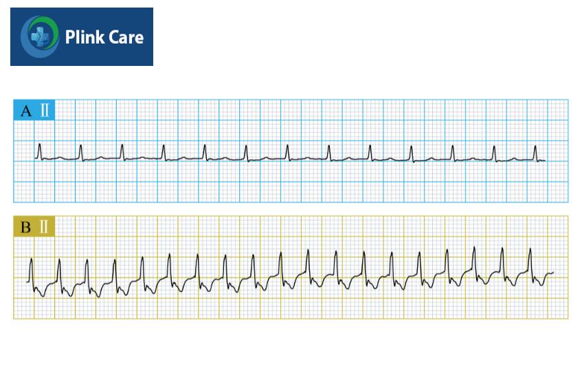 Kết quả từ điện tâm đồ (ECG) trên cho thấy bệnh nhân gặp tình trạng nhịp nhanh QRS hẹp