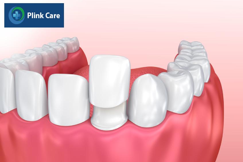 Cách điều trị mòn cổ chân răng