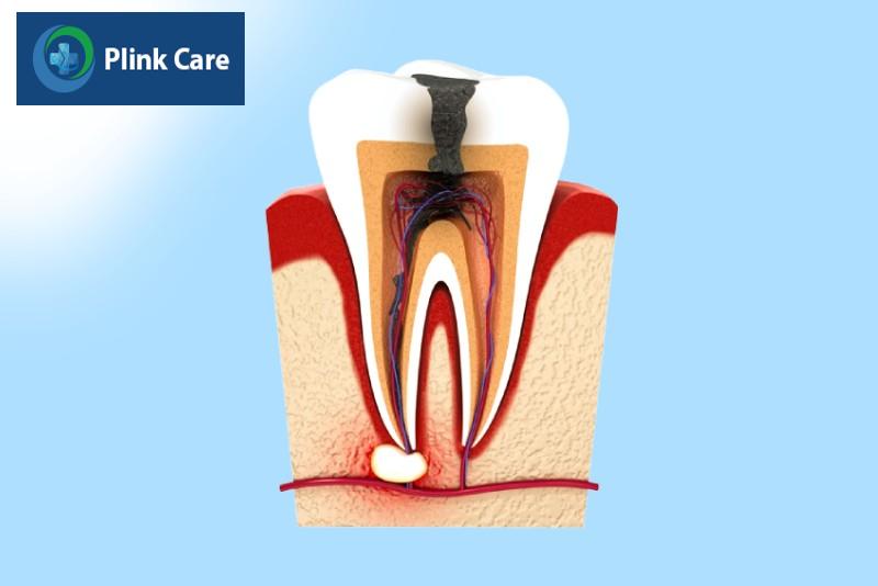 Những răng nào cần điều trị tủy răng?