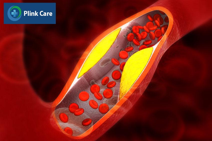 Hình ảnh minh họa động mạch bị hẹp do các mảng cholesterol bám vào thành động mạch gây giảm dòng máu đi qua