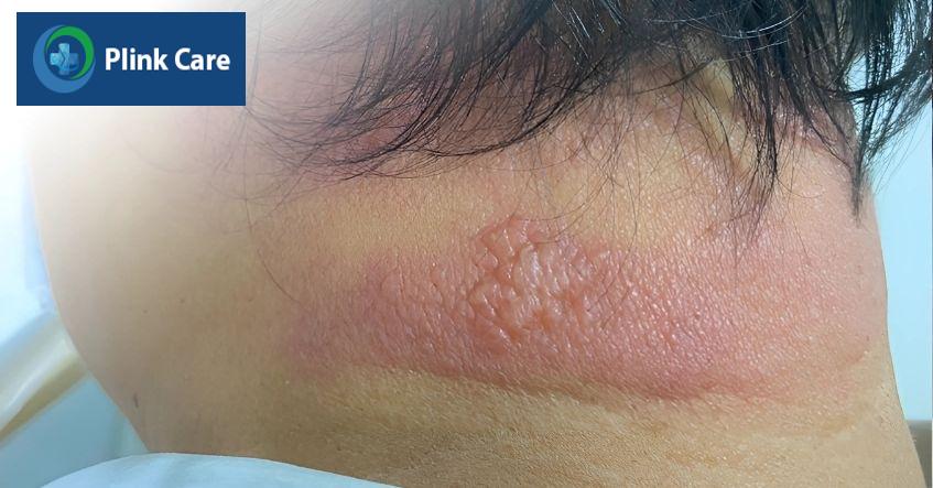 giời leo có thể để lại sẹo