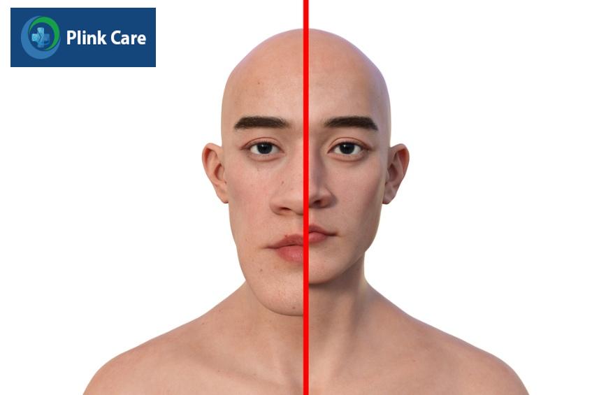 Gương mặt người bệnh to đầu chi