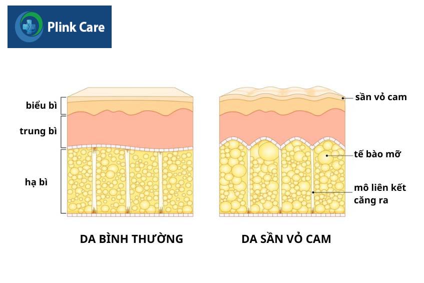 Hình ảnh da thường và da bị sần sùi vỏ cam