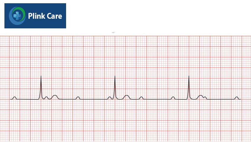 Kết quả ECG biểu hiện bệnh nhân đang mắc block nhĩ thất độ 3