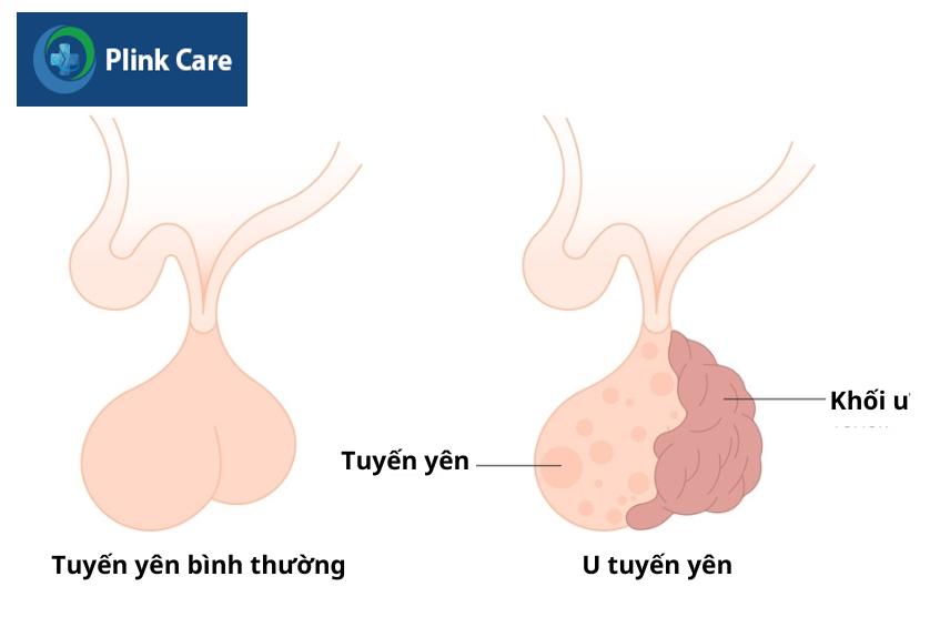 Khối u có thể ảnh hưởng đến chức năng tuyến yên