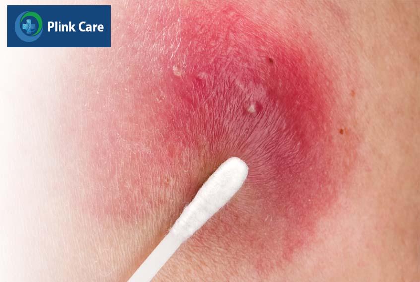 không nên nặn mụn nhọt khi chưa có mủ