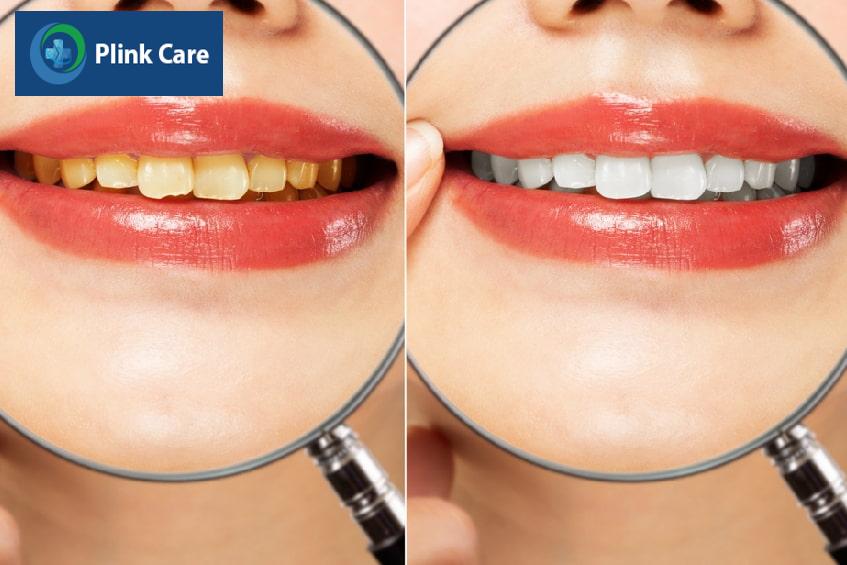 Răng xỉn màu có tẩy trắng được không?
