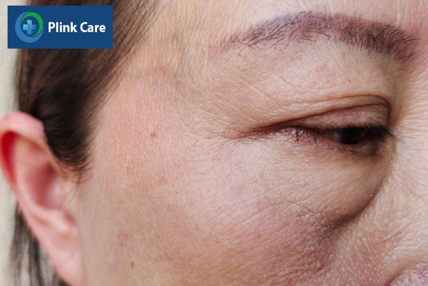lão hóa gây sụp mí mắt