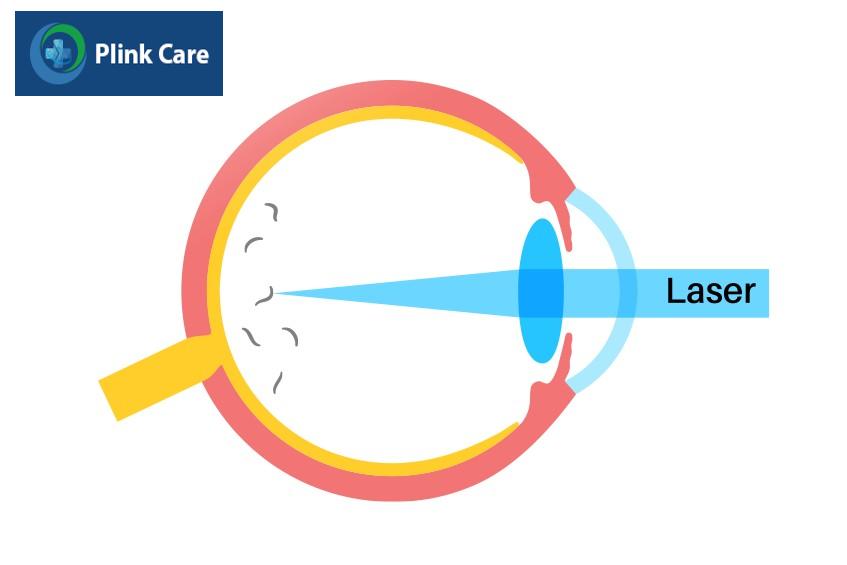 laser cải thiện vẩn đục dịch kính