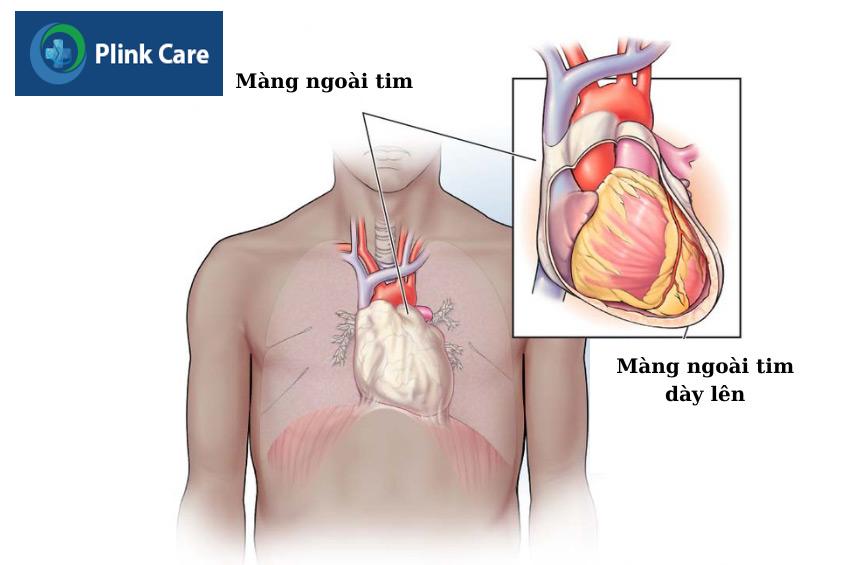 Màng ngoài tim cứng và dày lên ở bệnh nhân bị viêm màng ngoài tim co thắt