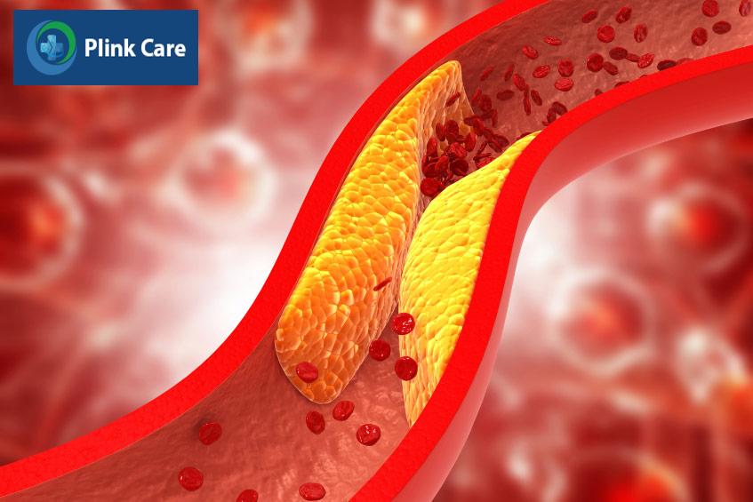 Mỡ máu tăng cao có thể gây tắc nghẽn trong lòng động mạch, do các mảng bám tích tụ