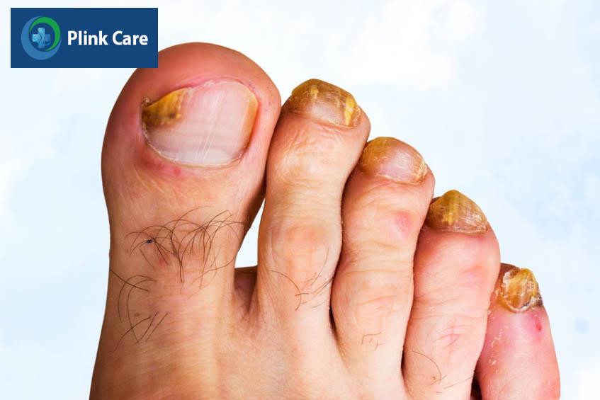 Móng ngón chân bị nấm