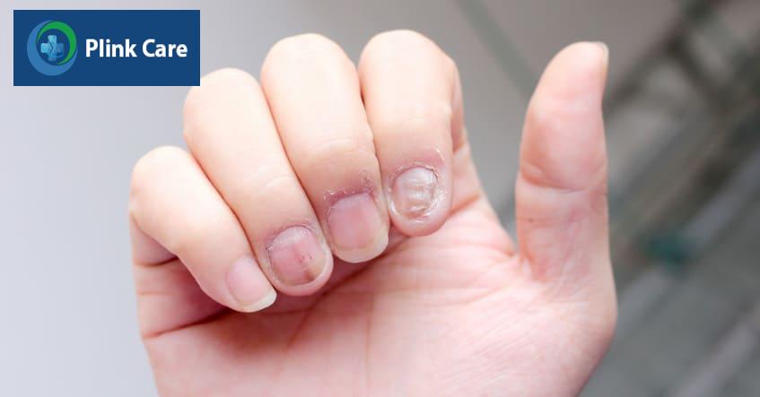 Nấm móng tay khiến móng trở nên giòn và dễ gãy