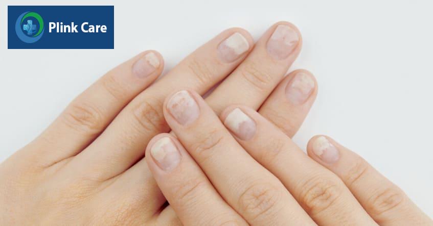 Nấm móng tay làm mất thẩm mỹ của móng tay
