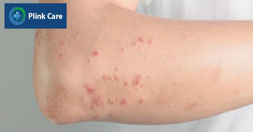 nguyên nhân nổi chấm đỏ trên da