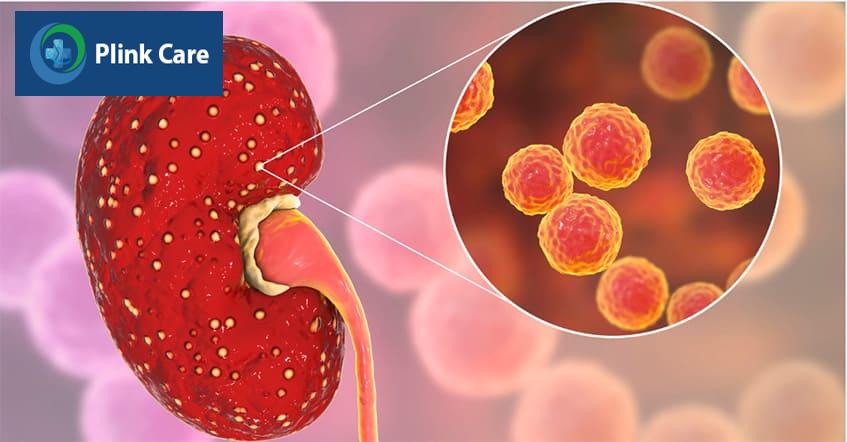 Nhiễm trùng thận gây đau đớn và khó chịu thường do viêm bàng quang gây ra