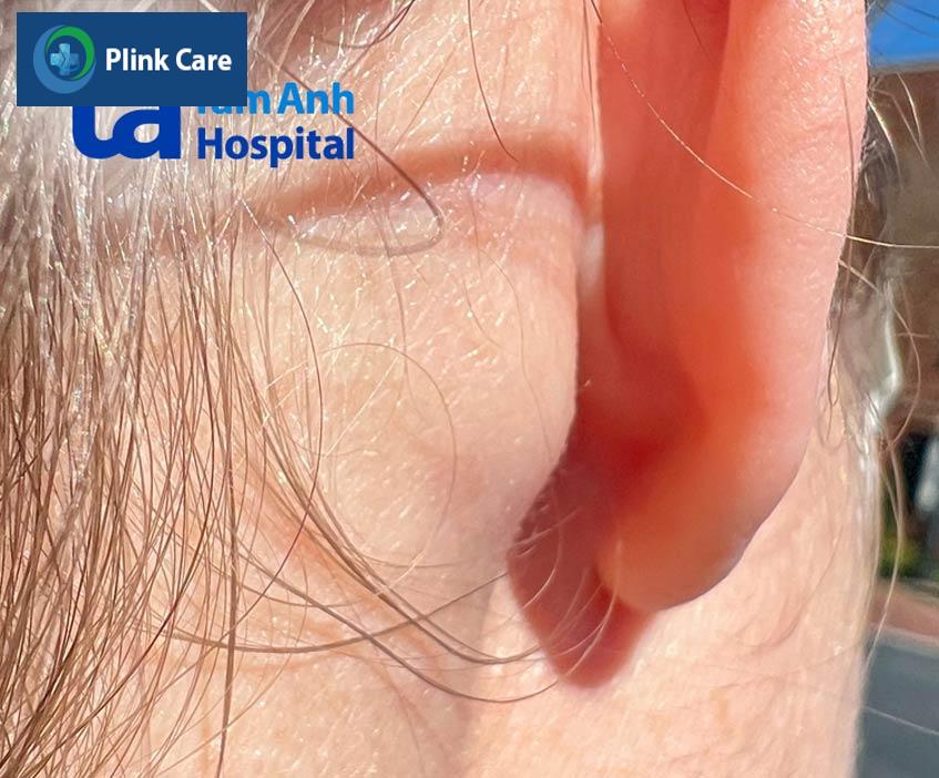 nổi hạch có thể là dấu hiệu nhiễm trùng