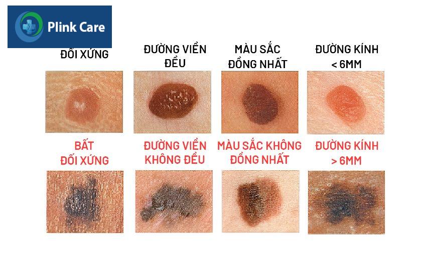 nốt ruồi bình thường và nốt ruồi ung thư hắc tố