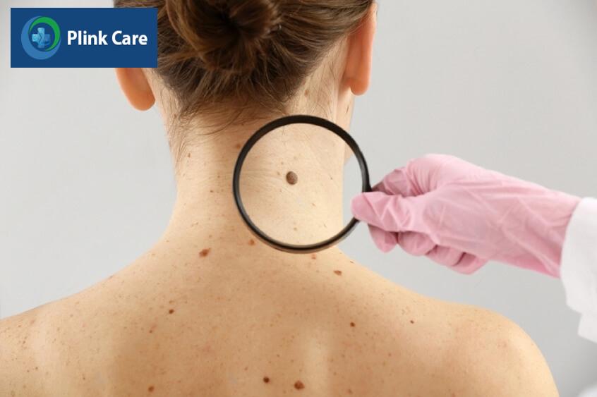 nốt ruồi ung thư hắc tố có thể nhô cao