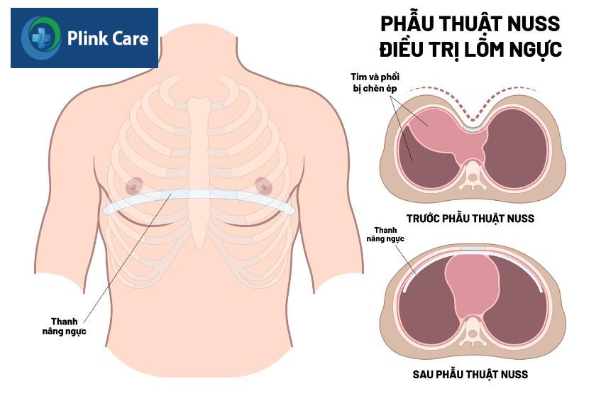 Phẫu thuật Nuss là phương pháp phổ biến trong điều trị lõm ngực