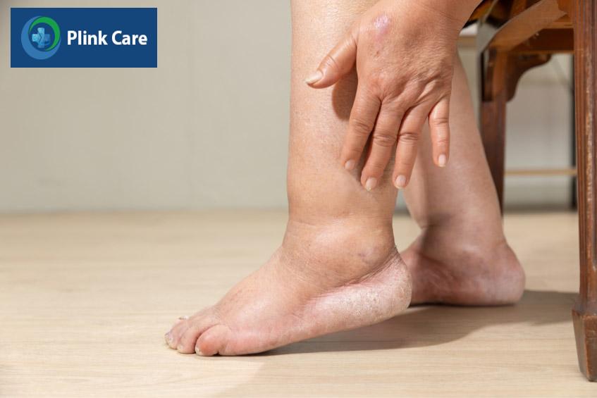 Bệnh nhân bị phù chân trong bối cảnh suy tim hay chèn ép tim cấp