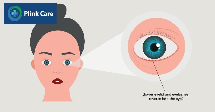 quặm mi dưới gây kích ứng mắt