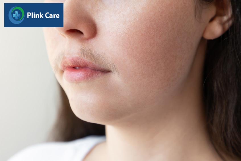 Rậm lông là một triệu chứng của buồng trứng đa nang