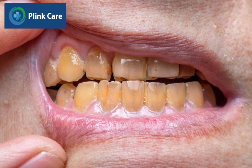 Răng bị xỉn màu có ảnh hưởng gì không?