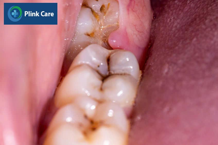 Các vị trí trên răng xuất hiện vệt đen thường gặp