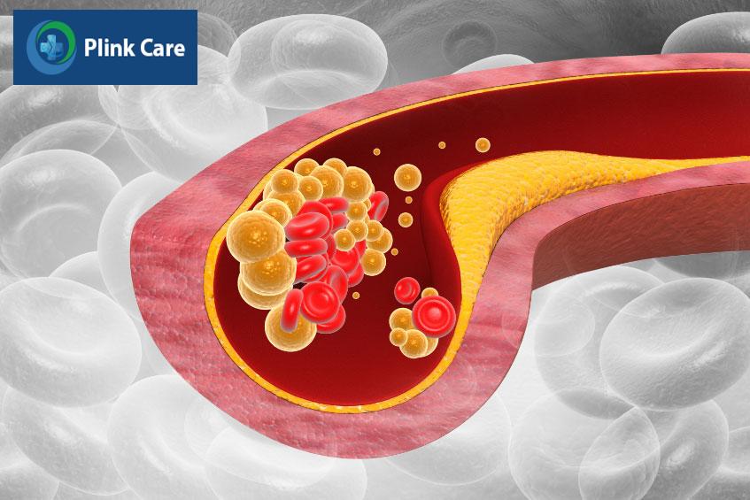 Rối loạn chuyển hóa chất béo xảy ra khi lượng lipid bất thường trong máu