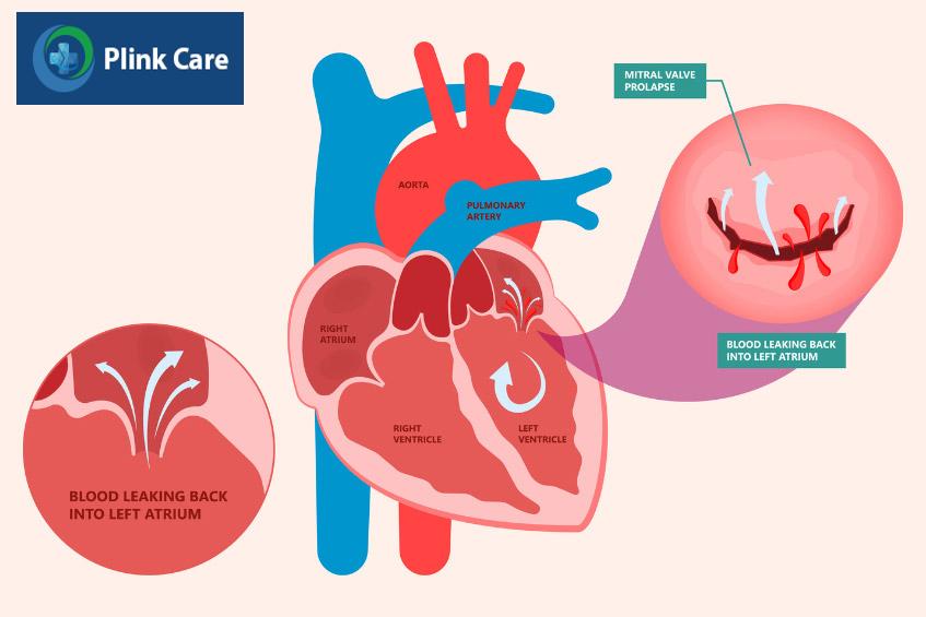 Sa van hai lá khiến máu rò rỉ ngược lại tâm nhĩ trái