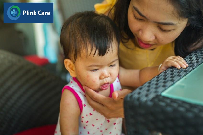 Sởi ở trẻ dưới 1 tuổi cần được phát hiện và điều trị đúng cách