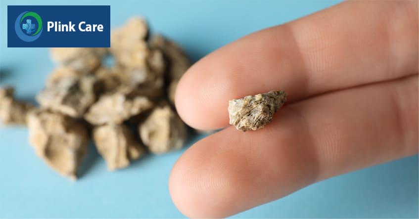 Sỏi tiết niệu có thể gây khó khăn trong việc điều trị viêm bàng quang