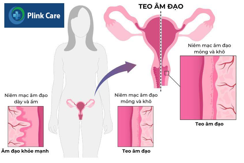 Teo âm đạo là bệnh lý phổ biến ở phụ nữ trong giai đoạn mãn kinh
