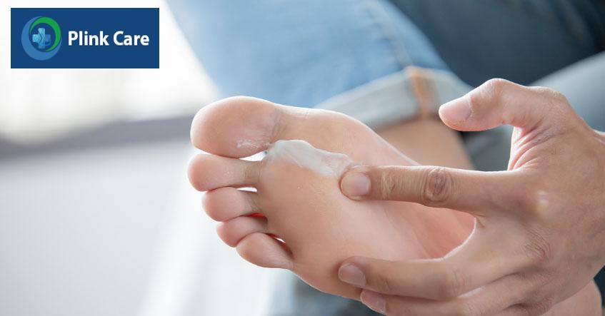 Thoa thuốc trị viêm da cơ địa bàn chân