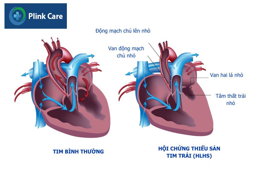Hình ảnh tim bình thường và tim mắc hội chứng thiểu sản tim trái (HLHS)