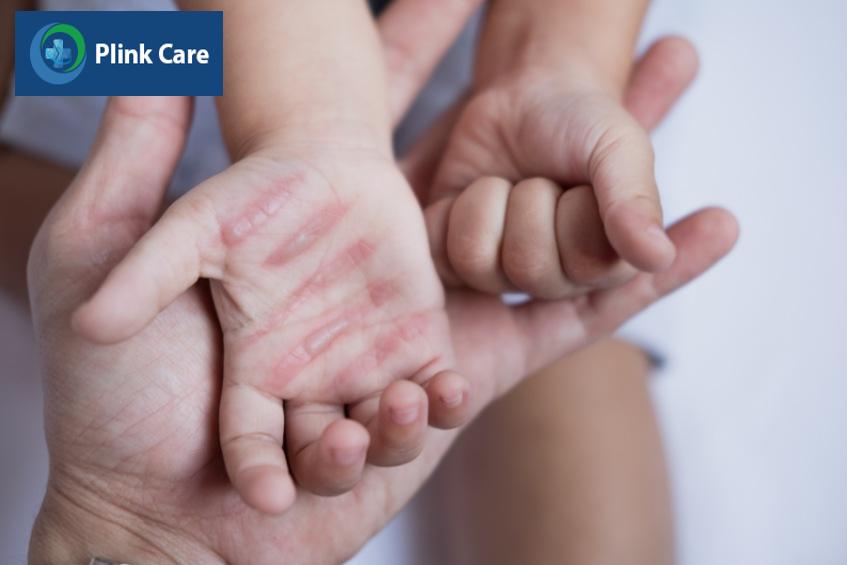 Tránh làm vỡ vết phồng rộp tại vùng da bị bỏng