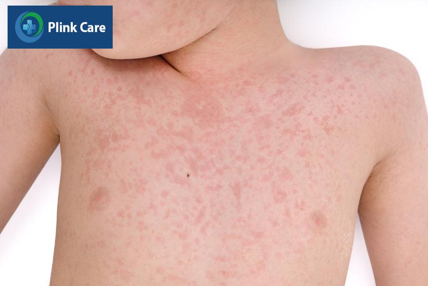 Trẻ bị sởi phát ban đỏ toàn thân