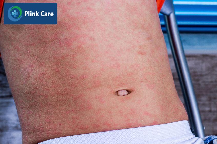 Trẻ bị sởi phát ban hồng toàn thân